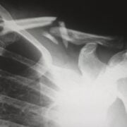 An x - ray of a person's shoulder.