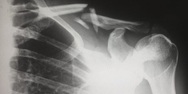 An x - ray of a person's shoulder.